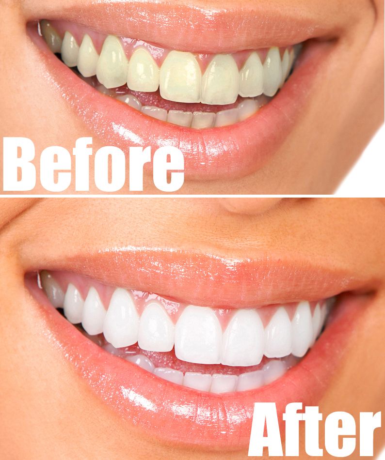 ways for teeth whitening